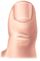 내향성발톱 증상