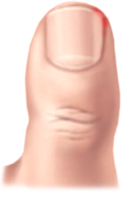 내향성발톱 증상