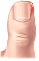 내향성발톱 증상