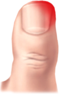 내향성발톱 증상